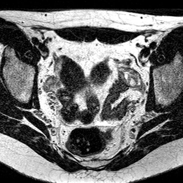 File:Bicornuate uterus (Radiopaedia 11104-11492 Axial T2 23).jpg