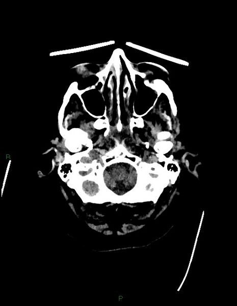 File:Bilateral acute middle cerebral artery territory infarcts (Radiopaedia 77319-89401 Axial non-contrast 8).jpg