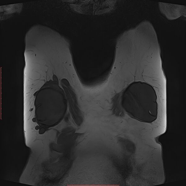 File:Bilateral breast implant rupture (Radiopaedia 24761-25027 G 53).jpg