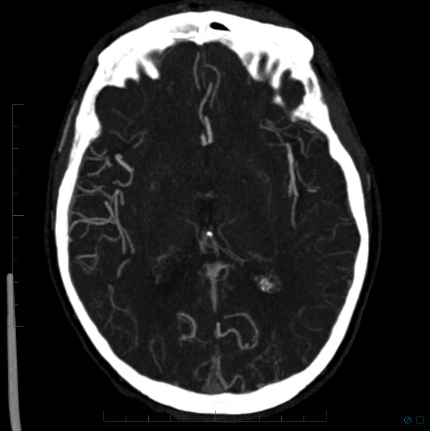 Bilateral chronic common carotid occlusion (Radiopaedia 50849-56362 D 15).jpg