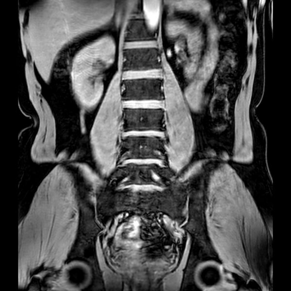 File:Bilateral conjoined nerve roots at different levels (Radiopaedia 73312-84063 Coronal WE 25).jpg