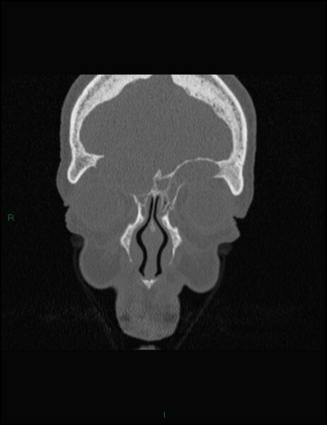 File:Bilateral frontal mucoceles (Radiopaedia 82352-96454 Coronal 81).jpg