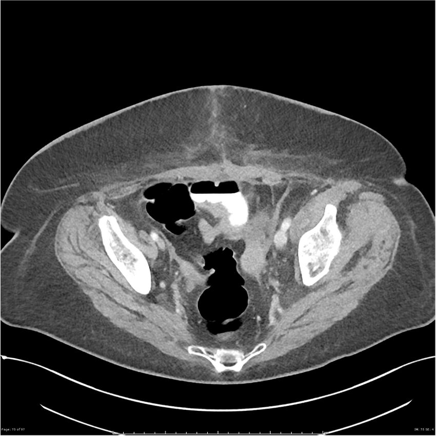 Bilateral psoas hematomas (Radiopaedia 24057-24279 A 75).jpg