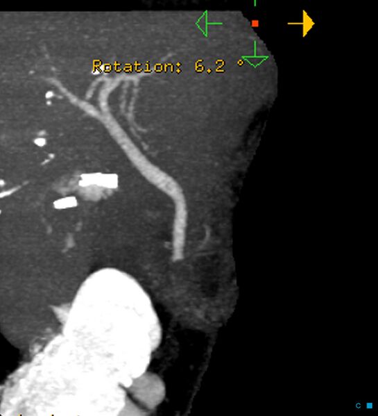 File:Bile leak from accessory duct(s) of Luschka post cholecystectomy (Radiopaedia 40736-43389 D 1).jpg