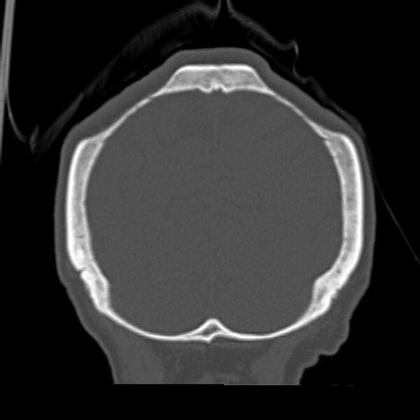 File:Biparietal osteodystrophy (Radiopaedia 46109-50463 Coronal bone window 89).jpg
