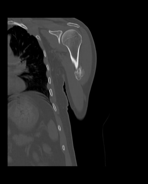 File:Bizarre parosteal osteochondromatous proliferation (Radiopaedia 84221-99501 Coronal bone window 11).jpg