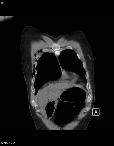 File:Boerhaave syndrome with tension pneumothorax (Radiopaedia 56794-63605 B 4).jpg