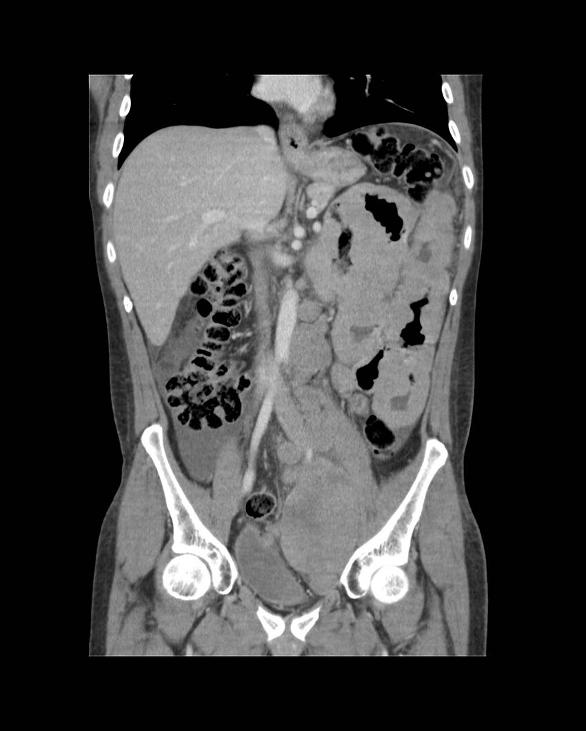 Bowel lymphoma complicated by bleeding after therapy (Radiopaedia 55601-62107 B 35).jpg