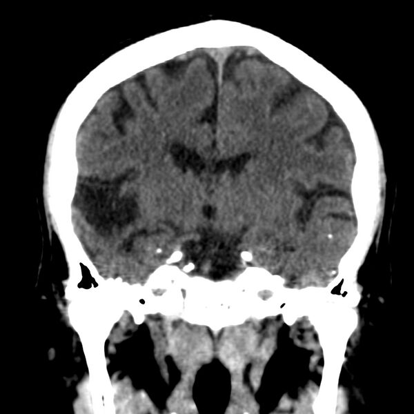 File:Brain Pantopaque remnants (Radiopaedia 78403-91048 Coronal non-contrast 36).jpg