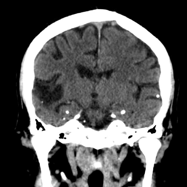 File:Brain Pantopaque remnants (Radiopaedia 78403-91048 Coronal non-contrast 37).jpg