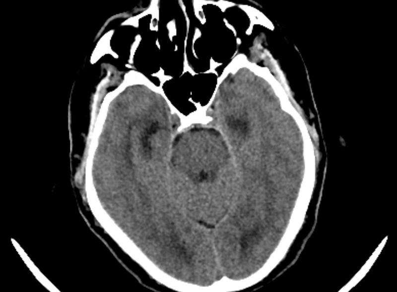 File:Brain abscess complicated by intraventricular rupture and ventriculitis (Radiopaedia 82434-96575 Axial non-contrast 2).jpg