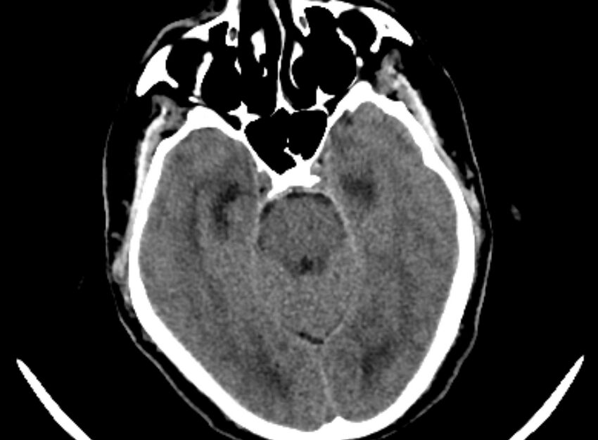 Brain abscess complicated by intraventricular rupture and ventriculitis (Radiopaedia 82434-96575 Axial non-contrast 2).jpg