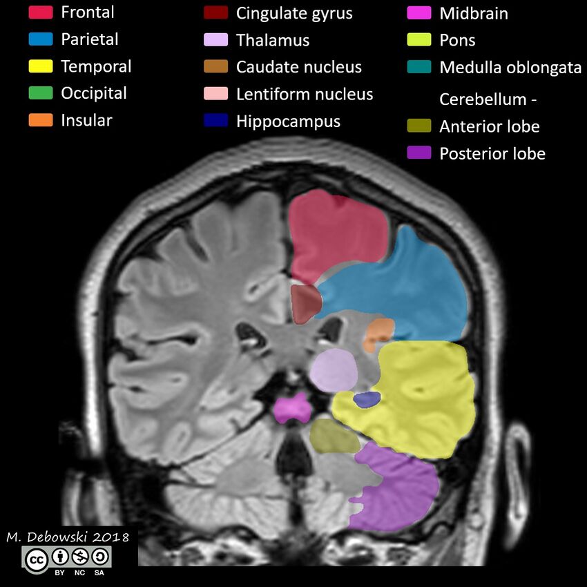 Brain lobes - annotated MRI (Radiopaedia 61691-69700 Coronal 45).JPG