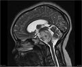 Brainstem glioma (Radiopaedia 21819-21775 Sagittal T2 12).jpg