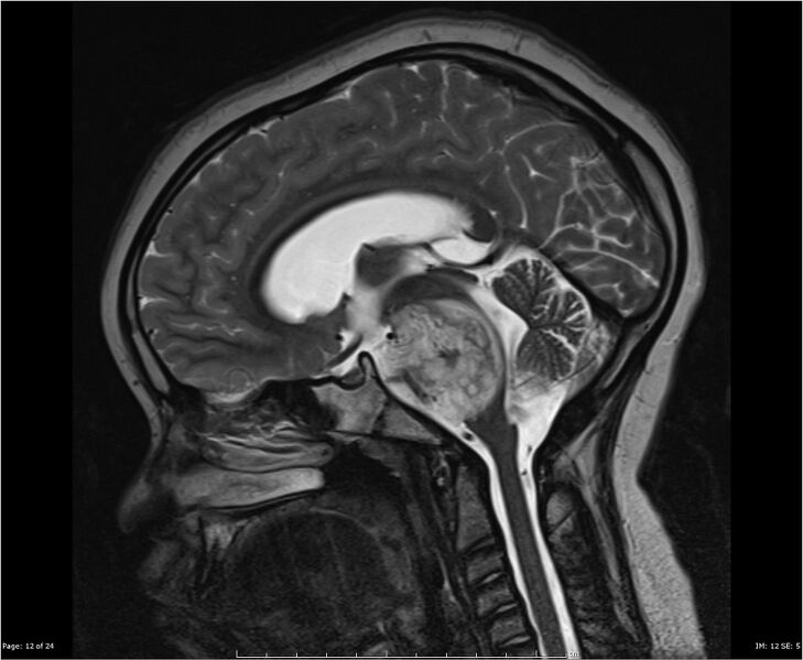 File:Brainstem glioma (Radiopaedia 21819-21775 Sagittal T2 12).jpg