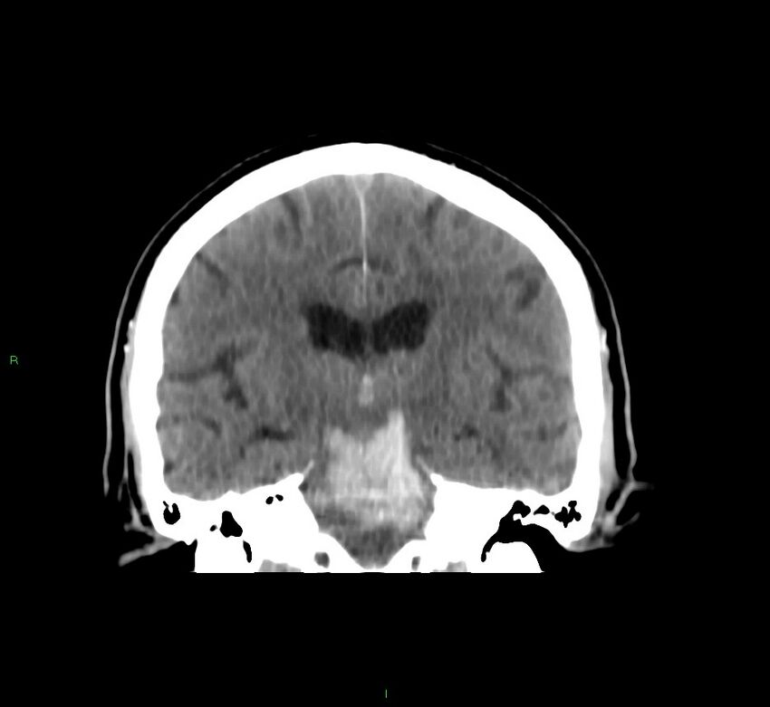 Brainstem hemorrhage (Radiopaedia 58794-66028 Coronal non-contrast 32).jpg