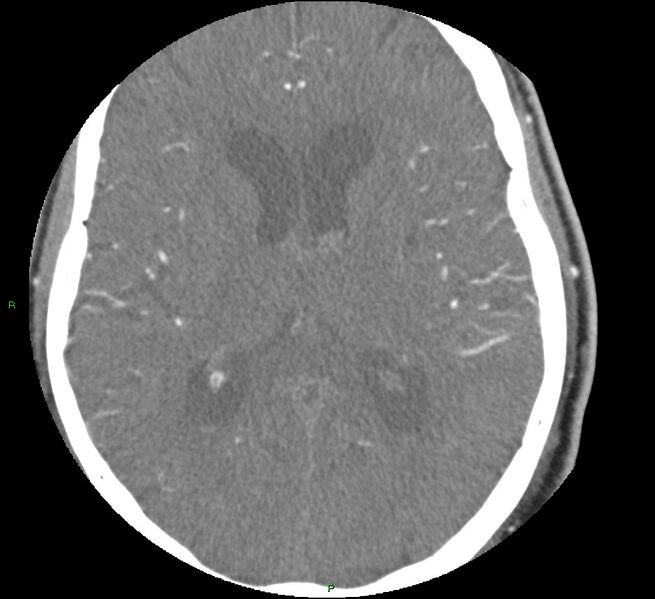 File:Brainstem hemorrhage (Radiopaedia 58794-66028 D 106).jpg