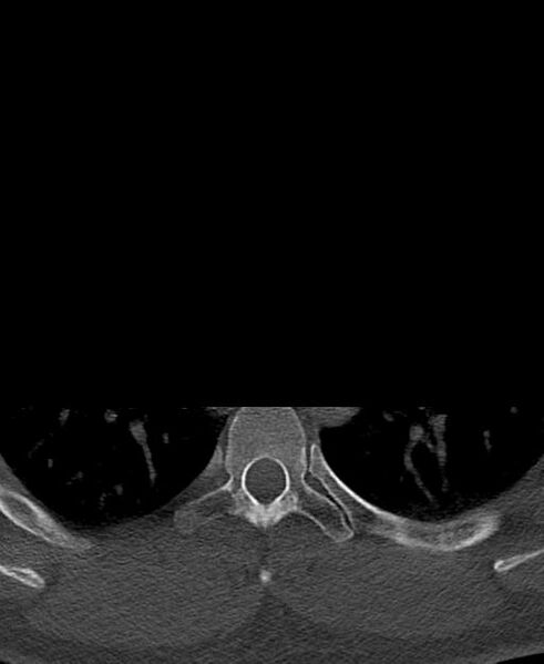 File:Branchial cleft cyst (Radiopaedia 31167-31875 Axial bone window 90).jpg