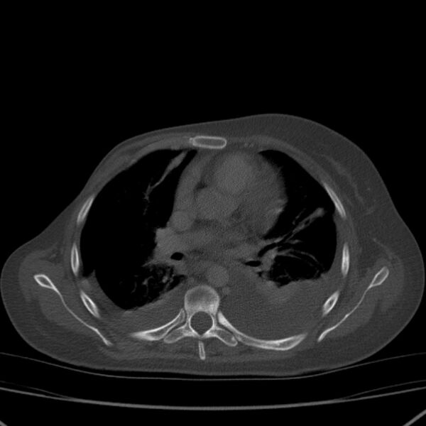 File:Breast cancer metastases - hepatic and skeletal (Radiopaedia 34201-35461 Axial bone window 20).jpg