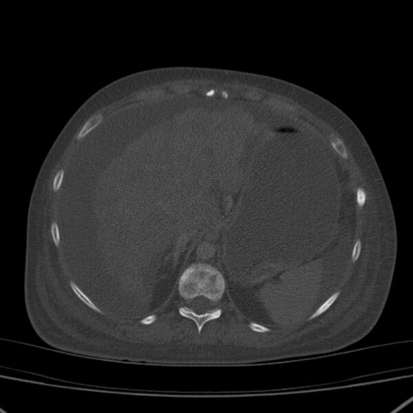 File:Breast cancer metastases - hepatic and skeletal (Radiopaedia 34201-35461 Axial bone window 40).jpg