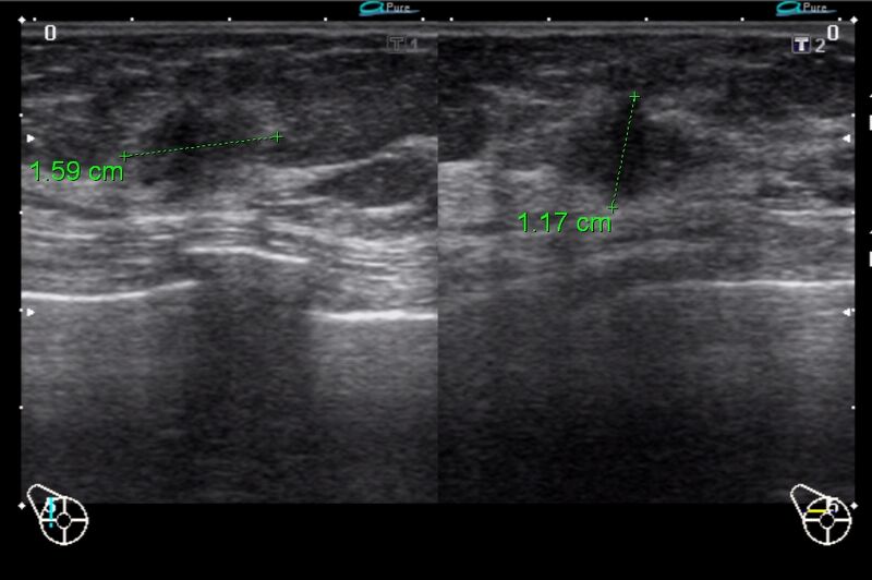 File:Breast cancer on ultrasound (Radiopaedia 15840-15491 C 1).jpg