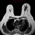Breast carcinoma (multicentric multifocal in mammary Paget disease) (Radiopaedia 50966-56512 Axial T2 14).jpg