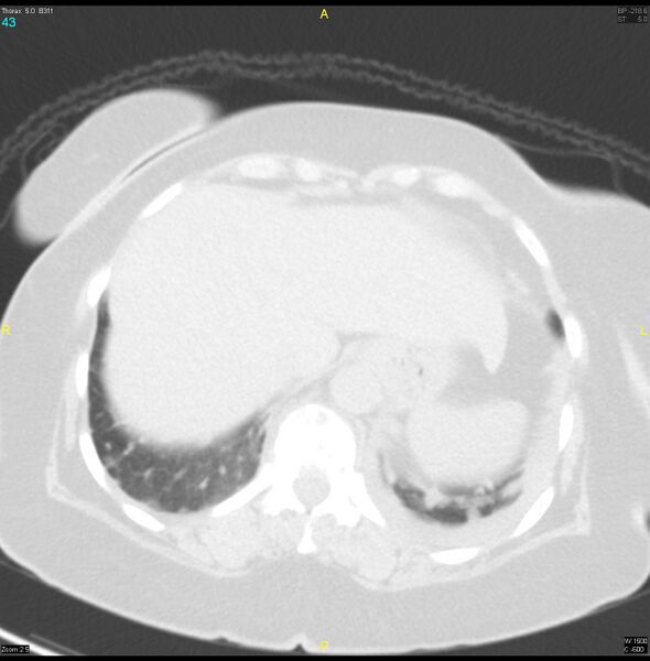 File:Breast primary with lung and bone metastases (Radiopaedia 40620-43228 Axial lung window 43).jpg