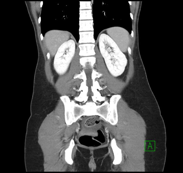 File:Broad ligament hernia (Radiopaedia 63260-71832 B 28).jpg