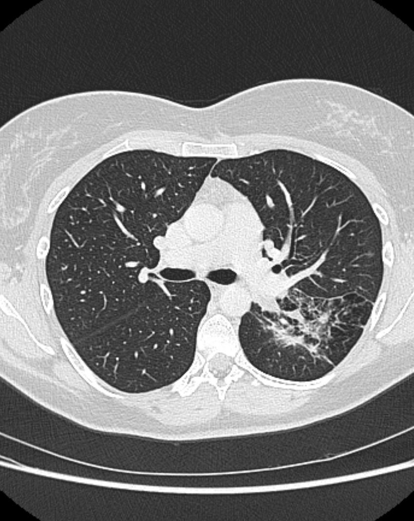 Bronchial atresia (Radiopaedia 50007-55297 Axial lung window 43).jpg