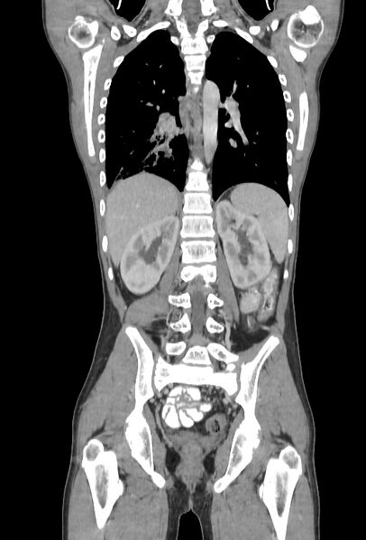 File:Bronchial carcinoid tumor (Radiopaedia 57187-64090 B 80).jpg