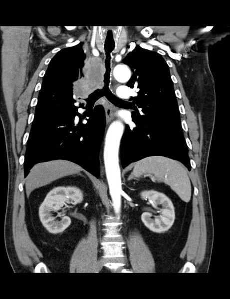 File:Bronchial carcinoma (Radiopaedia 18285-18112 A 5).jpg