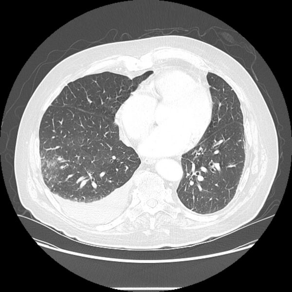 File:Bronchogenic adenocarcinoma and pulmonary embolism (Radiopaedia 9097-9806 Axial lung window 20).jpg