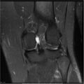 Bucket handle tear - lateral meniscus (Radiopaedia 7246-8187 Coronal T2 fat sat 7).jpg