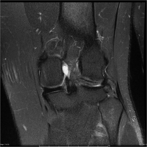 File:Bucket handle tear - lateral meniscus (Radiopaedia 7246-8187 Coronal T2 fat sat 7).jpg