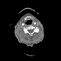 C2 fracture with vertebral artery dissection (Radiopaedia 37378-39200 A 129).png