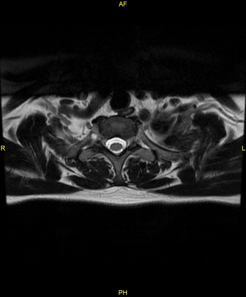 C5 nerve sheath tumor (Radiopaedia 85777-101596 Axial T2 85).jpg