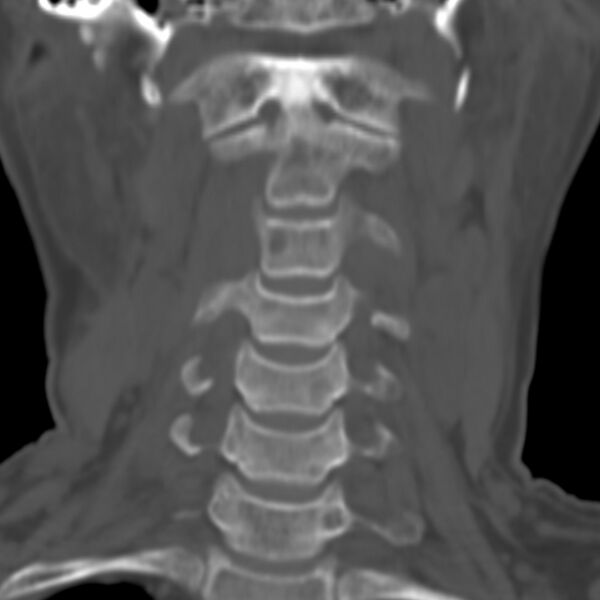File:Calcified meningioma - cervical canal (Radiopaedia 70136-80171 Coronal bone window 1).jpg