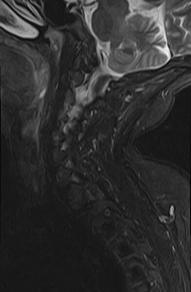 File:Calcified meningioma - cervical canal (Radiopaedia 70136-82468 Sagittal STIR 5).jpg