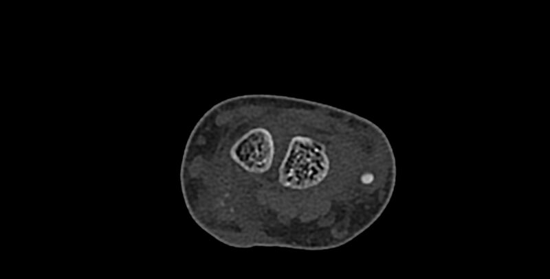 File:Calcifying aponeurotic fibroma (Radiopaedia 88423-105064 Axial bone window 50).jpg