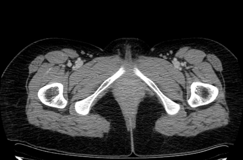 Cannonball metastases - uterine choriocarcinoma (Radiopaedia 70137-80174 A 75).jpg