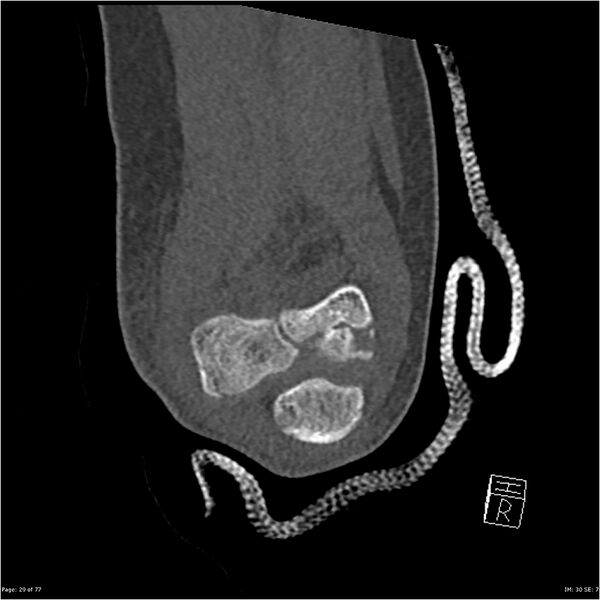 File:Capitellum fracture (Radiopaedia 23352-23426 Coronal bone window 29).jpg