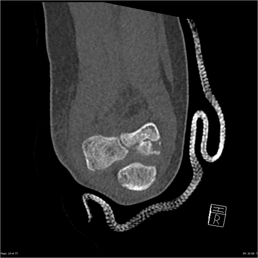 Capitellum fracture (Radiopaedia 23352-23426 Coronal bone window 29).jpg
