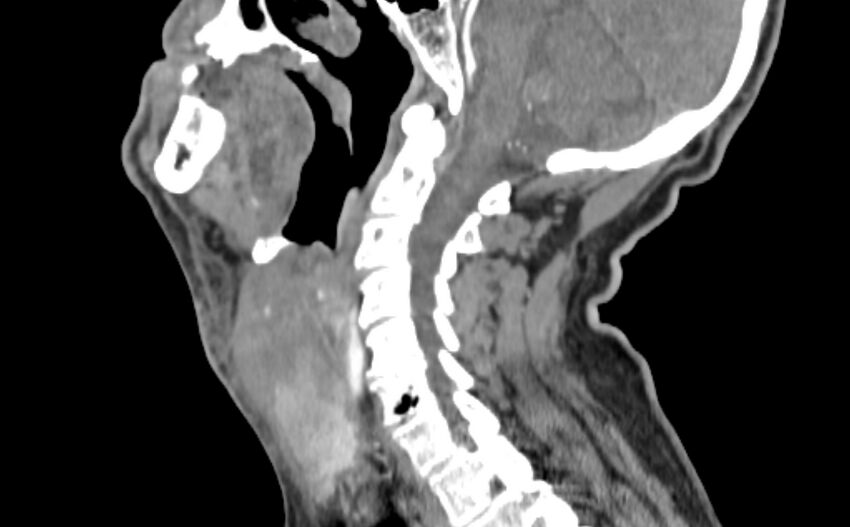 Carotid artery pseudoaneurysm (Radiopaedia 84030-99259 E 12).jpg