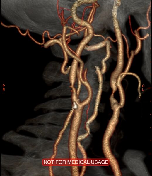 File:Carotid artery stenosis (Radiopaedia 28786-29086 A 12).jpg