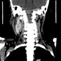 Carotid body tumor (Radiopaedia 27890-28124 B 4).jpg