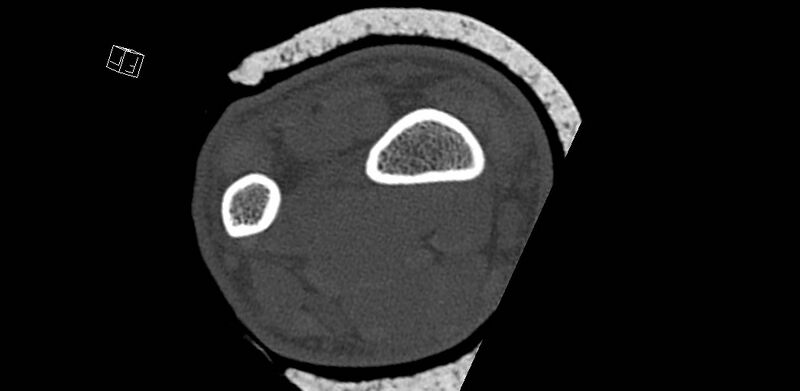 File:Carpal fractures (smart watch impaction) (Radiopaedia 55844-62430 Axial bone window 1).jpg