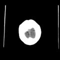 Cavum septum pellucidum (Radiopaedia 23163-23217 Coronal non-contrast 50).jpg
