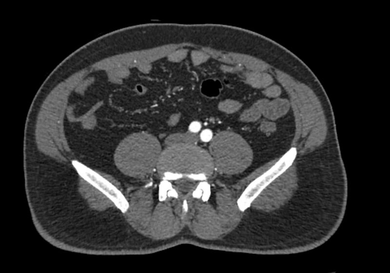 File:Celiac artery dissection (Radiopaedia 52194-58080 A 75).jpg