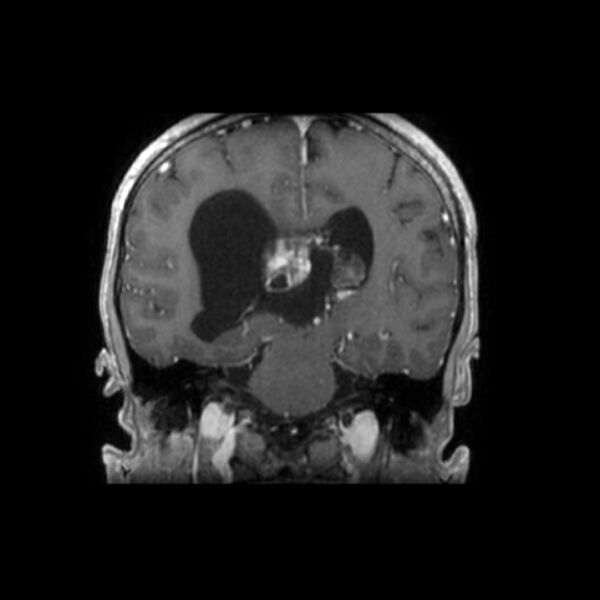 File:Central neurocytoma (Radiopaedia 67618-77021 Coronal T1 C+ 13).jpg