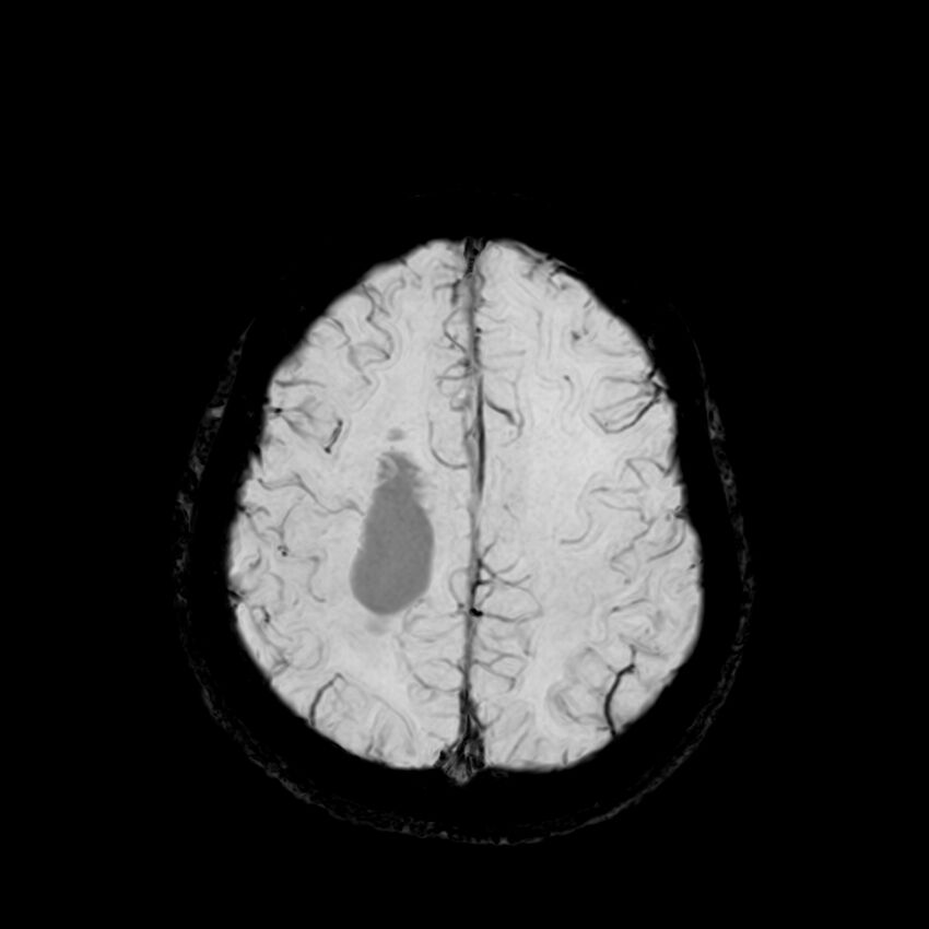 Central neurocytoma (Radiopaedia 79320-92380 Axial SWI 109).jpg